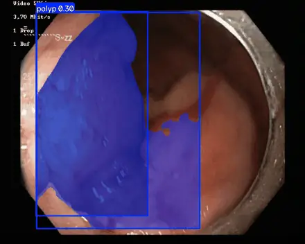Demo de EndoTector segmentando un pólipo en una imagen de endoscopia